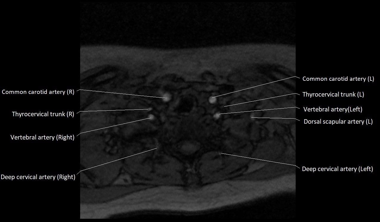 Carotid artery anatomy axial 3T image 65.jpg
